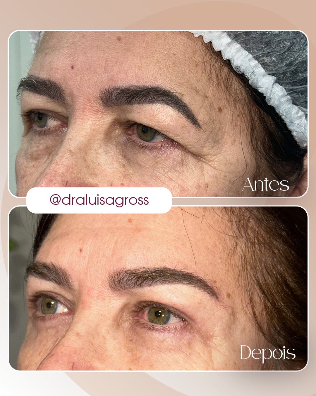 Rejuvenescimento do olhar