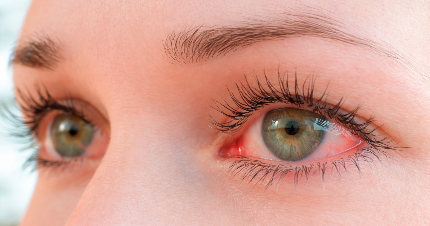 Blefaroplastia e olho seco: o que você precisa saber antes da cirurgia