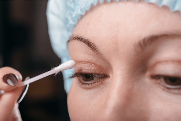 Pomadas na blefaroplastia: o que usar nos pontos e na cicatriz?
