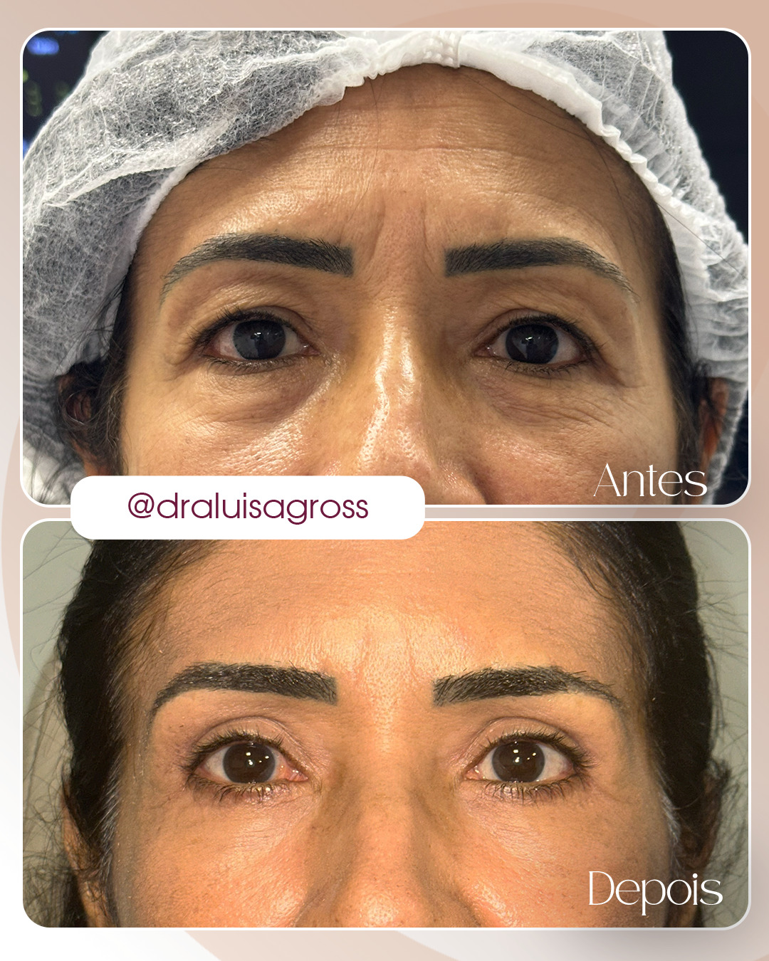 Blefaroplastia superior com laser de CO₂