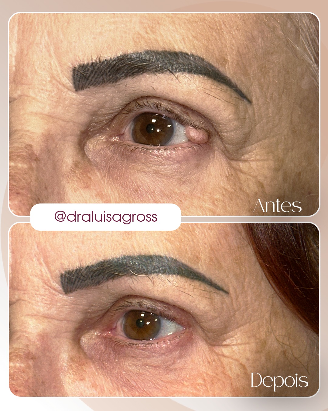 Correção de excesso de pele palpebral