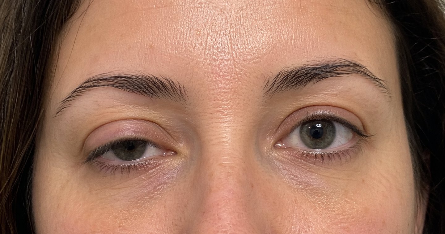 Ptose palpebral: quando o “olho caído” não se resolve apenas com blefaroplastia